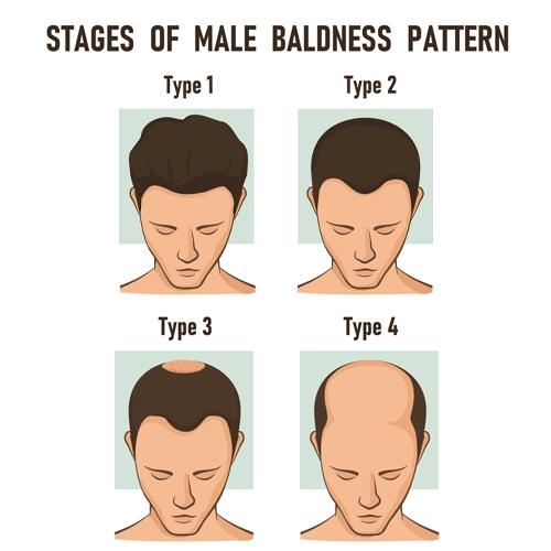 stages_of_male_baldness_pattern