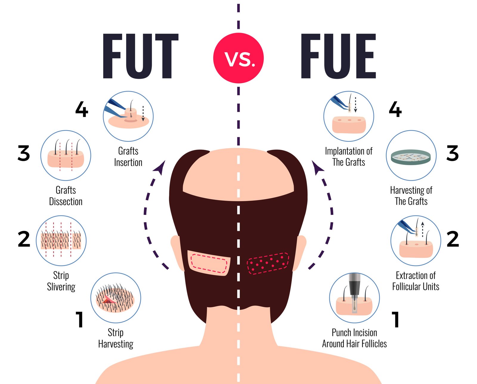 hair transplant treatment in coimbatore