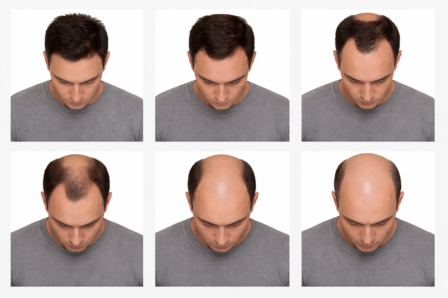 hair transplant treatment in coimbatore